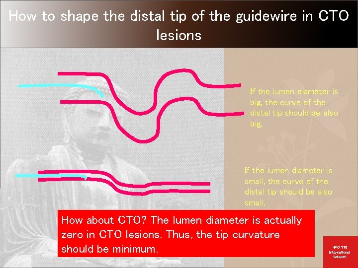 How to shape the distal tip of the guidewire in CTO lesions If the