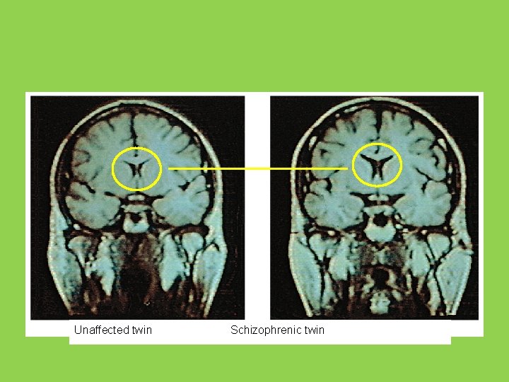 Unaffected twin Schizophrenic twin 