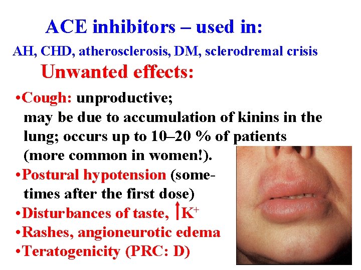 ACE inhibitors – used in: AH, CHD, atherosclerosis, DM, sclerodremal crisis Unwanted effects: •