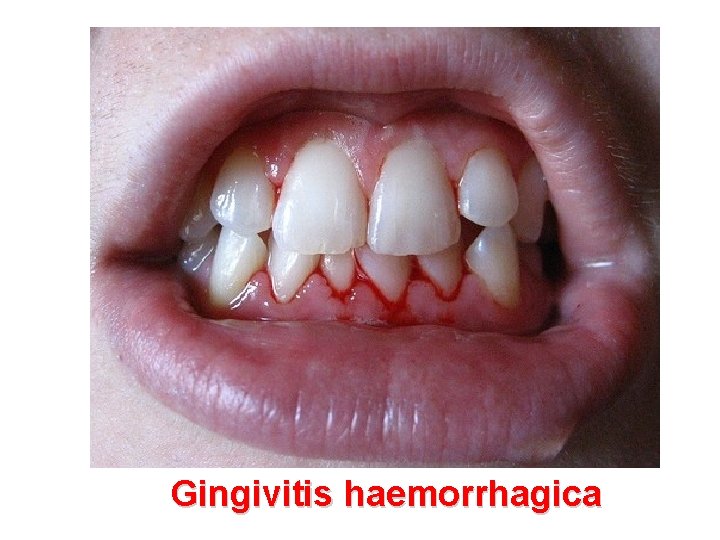 Gingivitis haemorrhagica 