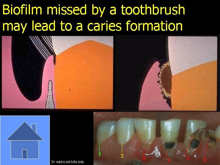 Biofilm missed by a toothbrush may lead to a caries formation 3× webs. wichita.