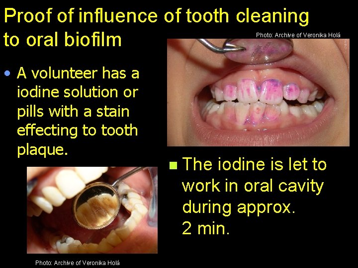 Proof of influence of tooth cleaning to oral biofilm Photo: Archive of Veronika Holá