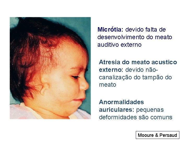 Micrótia: devido falta de desenvolvimento do meato auditivo externo Atresia do meato acustico externo: