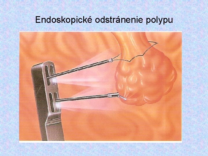 Endoskopické odstránenie polypu 