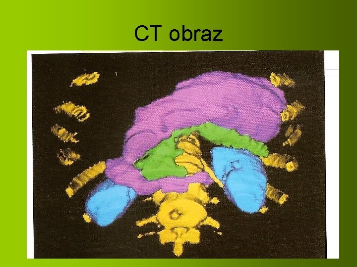 CT obraz 