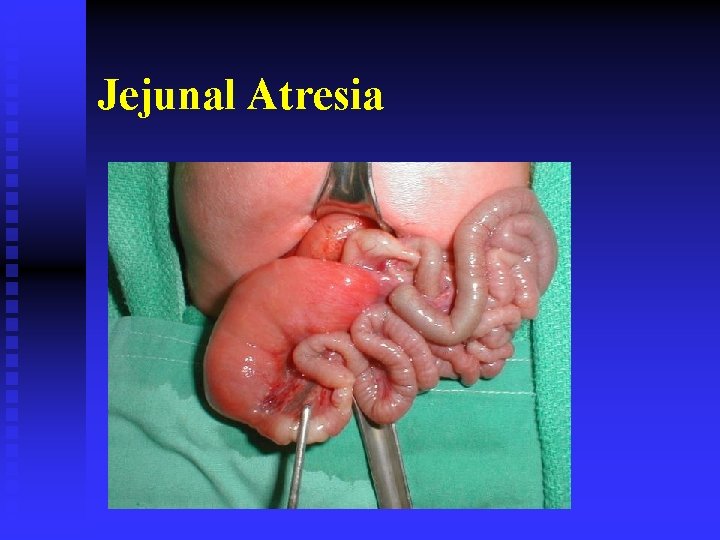 Jejunal Atresia 