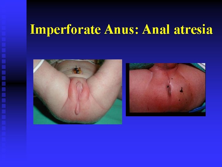 Imperforate Anus: Anal atresia 