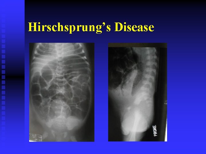 Hirschsprung’s Disease 