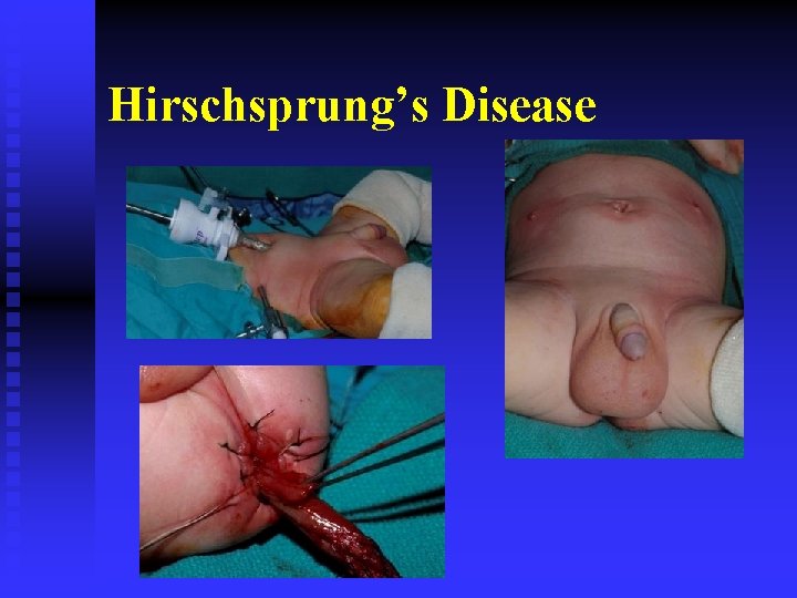 Hirschsprung’s Disease 