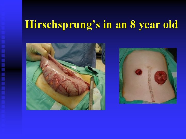 Hirschsprung’s in an 8 year old 