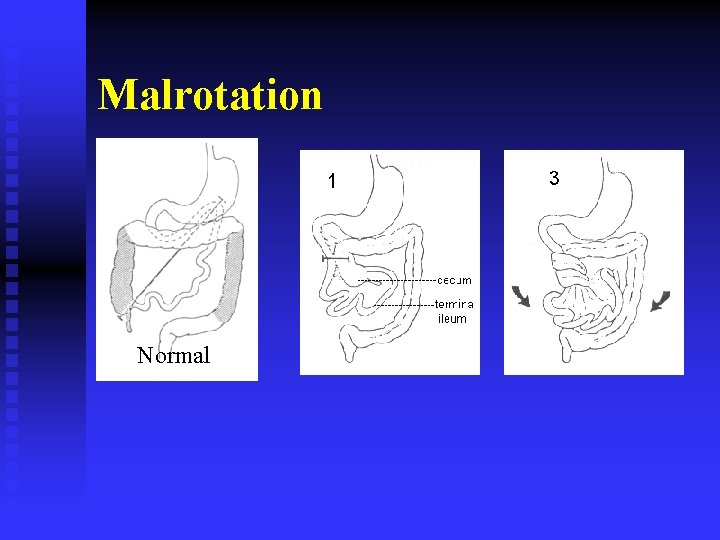 Malrotation Normal 