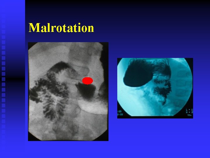 Malrotation 