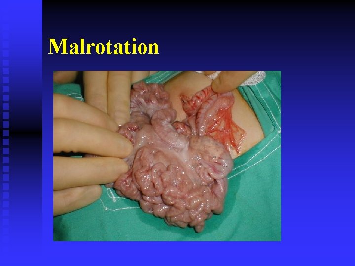 Malrotation 