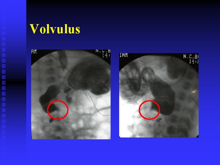Volvulus 