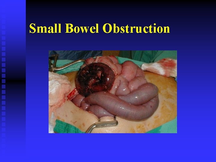 Small Bowel Obstruction 