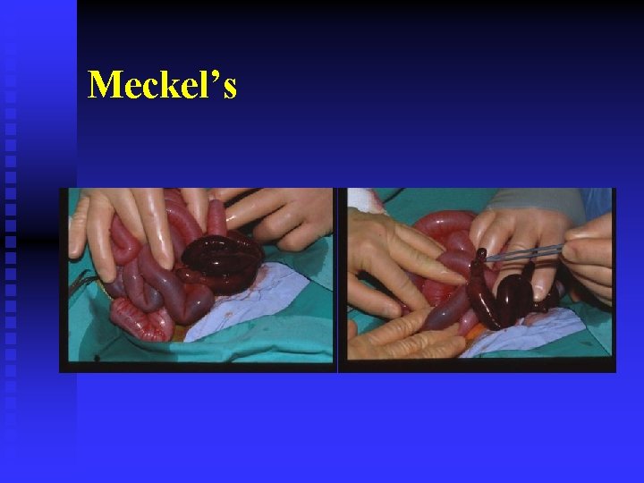 Meckel’s 