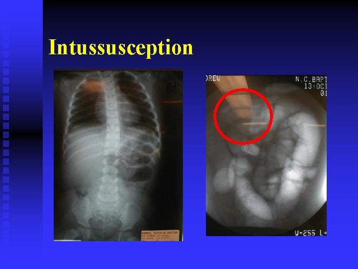 Intussusception 
