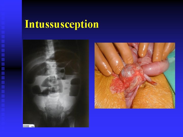 Intussusception 