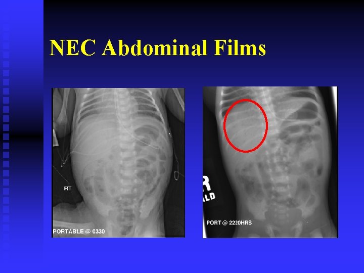 NEC Abdominal Films 