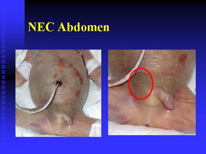 NEC Abdomen 