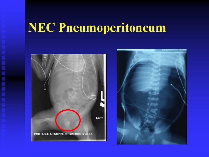 NEC Pneumoperitoneum 