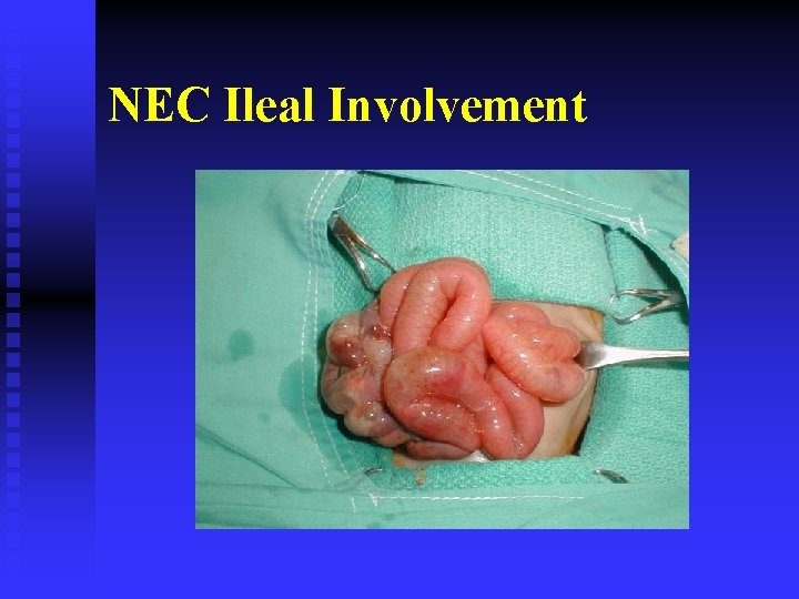NEC Ileal Involvement 