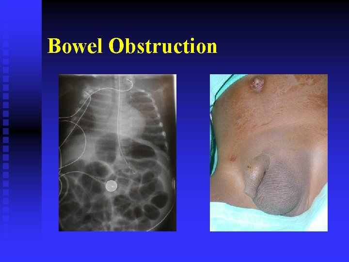 Bowel Obstruction 