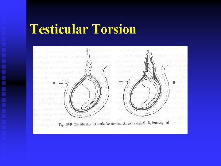 Testicular Torsion 