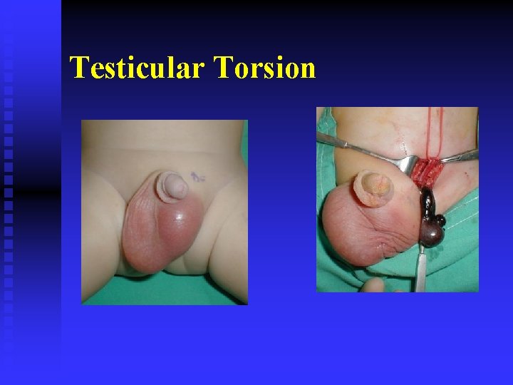 Testicular Torsion 