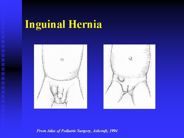 Inguinal Hernia From Atlas of Pediatric Surgery, Ashcraft, 1994 