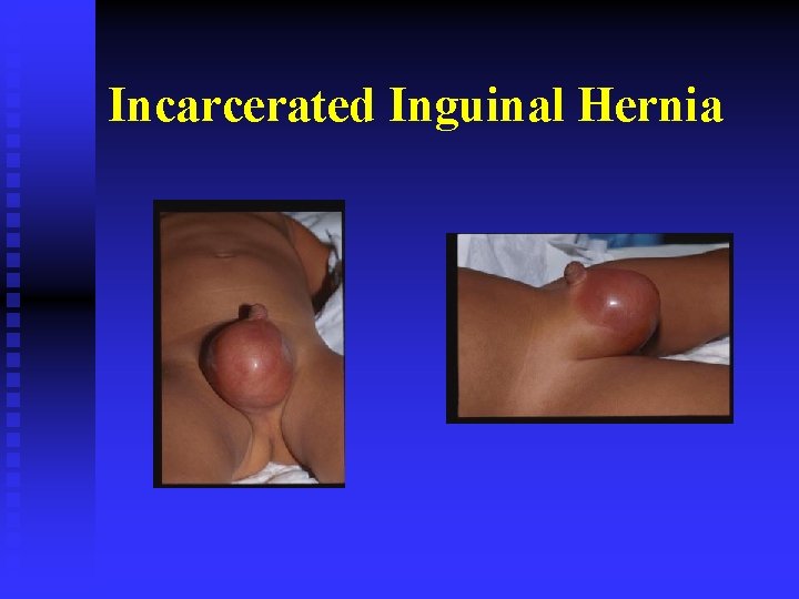 Incarcerated Inguinal Hernia 