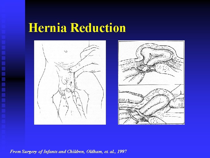 Hernia Reduction From Surgery of Infants and Children, Oldham, et. al. , 1997 