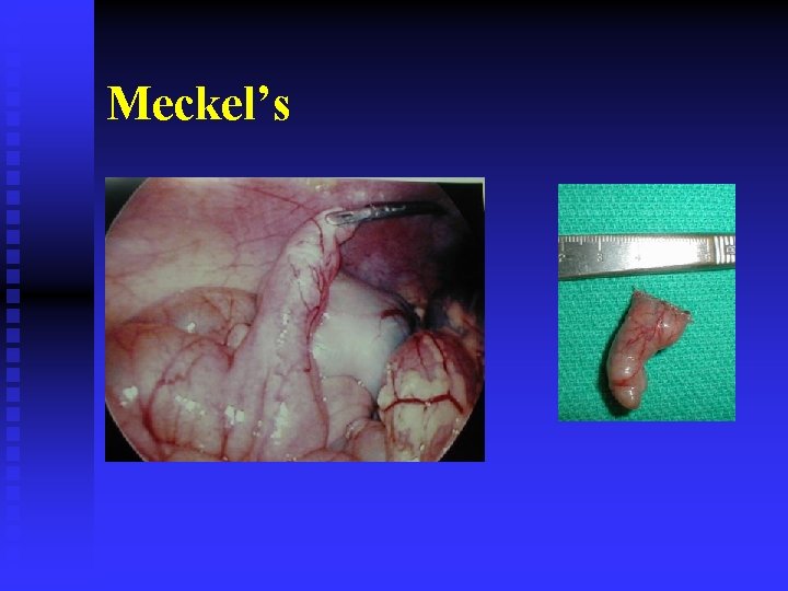 Meckel’s 