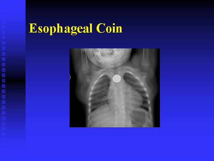 Esophageal Coin 