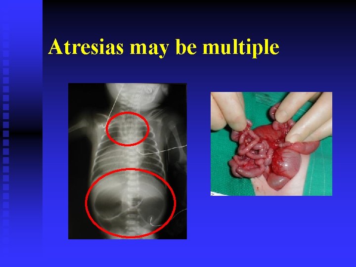 Atresias may be multiple 