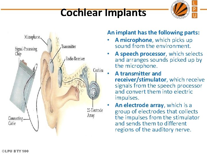 Cochlear Implants An implant has the following parts: • A microphone, which picks up