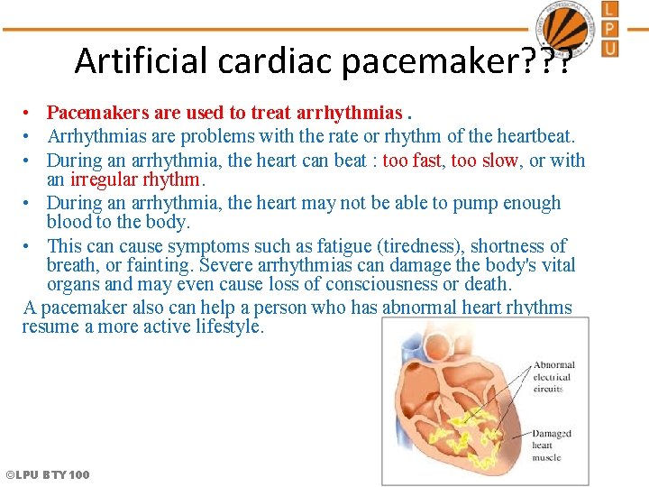 Artificial cardiac pacemaker? ? ? • Pacemakers are used to treat arrhythmias. • Arrhythmias