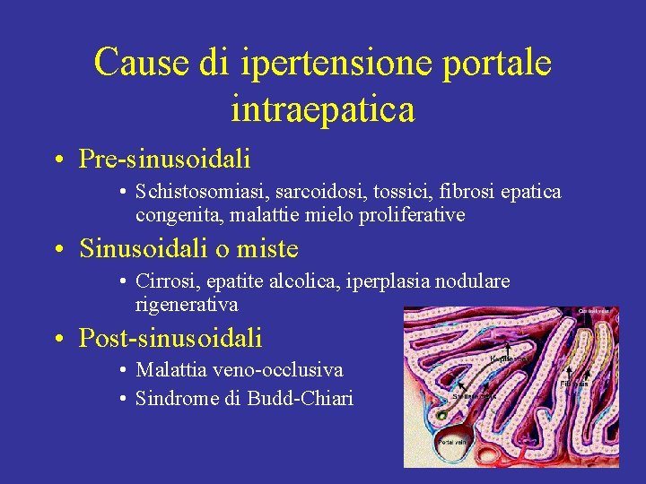 Cause di ipertensione portale intraepatica • Pre-sinusoidali • Schistosomiasi, sarcoidosi, tossici, fibrosi epatica congenita,