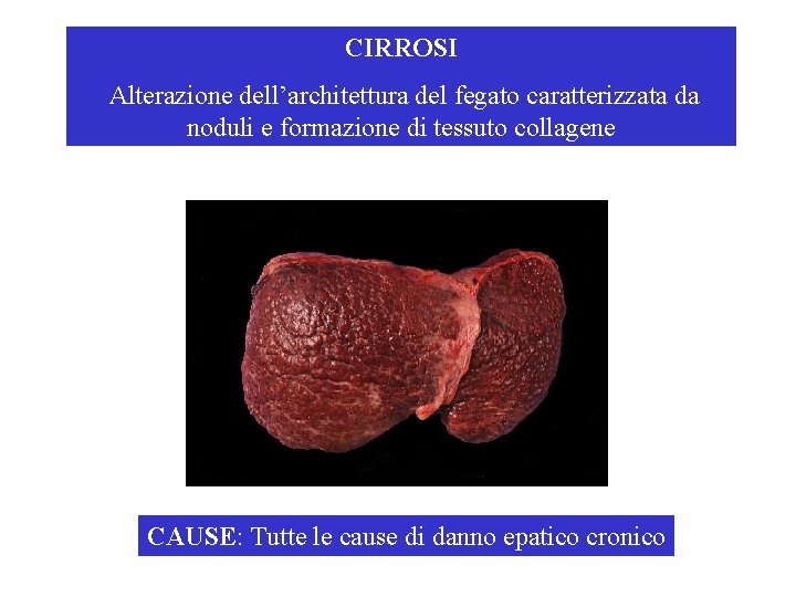 CIRROSI Alterazione dell’architettura del fegato caratterizzata da noduli e formazione di tessuto collagene CAUSE: