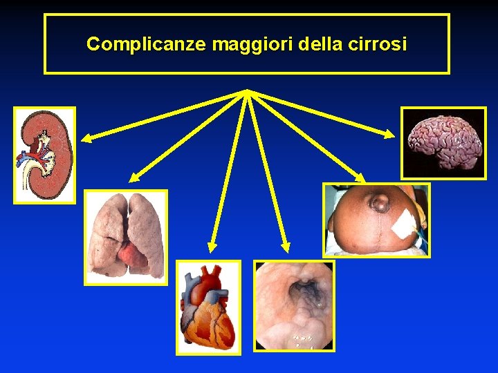 Complicanze maggiori della cirrosi 