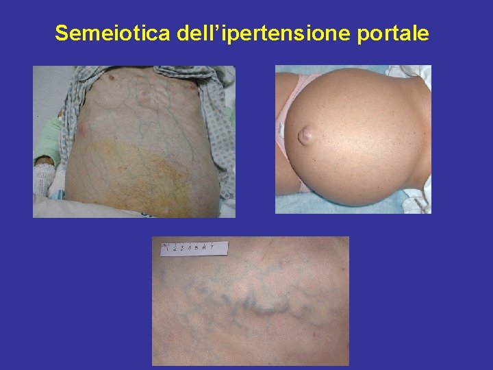 Semeiotica dell’ipertensione portale 