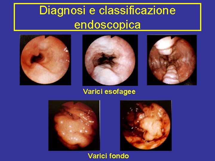 Diagnosi e classificazione endoscopica Varici esofagee Varici fondo 