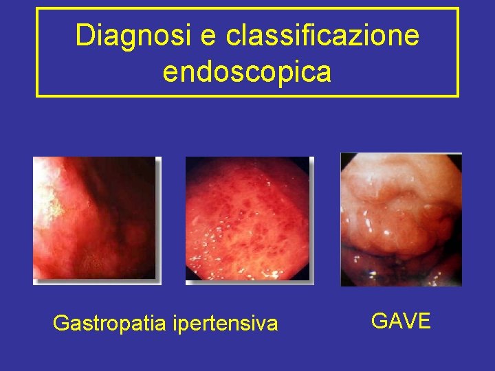 Diagnosi e classificazione endoscopica Gastropatia ipertensiva GAVE 