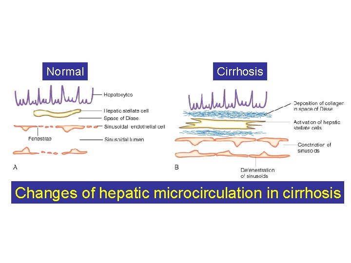 Normal Cirrhosis Changes of hepatic microcirculation in cirrhosis 