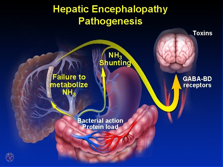 PATHOPHYSIOLOGY OF HEPATIC ENCEPHALOPATHY Hepatic Encephalopathy Pathogenesis Toxins NH 3 Shunting Failure to metabolize