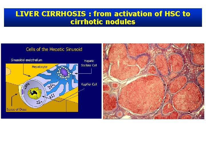 LIVER CIRRHOSIS : from activation of HSC to cirrhotic nodules 