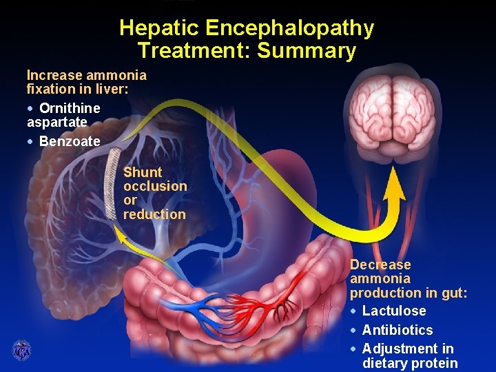 HEPATIC ENCEPHALOPATHY – TREATMENT SUMMARY Hepatic Encephalopathy Treatment: Summary Increase ammonia fixation in liver: