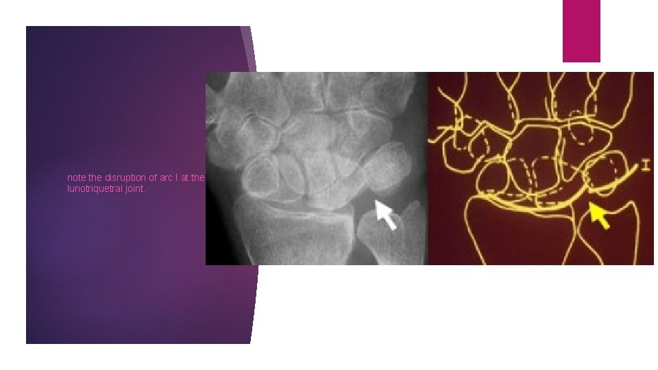 note the disruption of arc I at the lunotriquetral joint. 