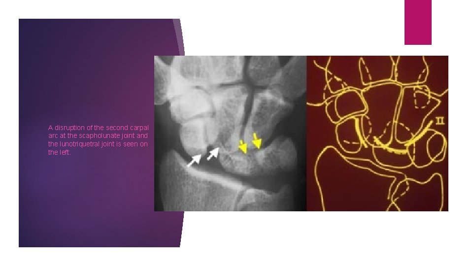 A disruption of the second carpal arc at the scapholunate joint and the lunotriquetral