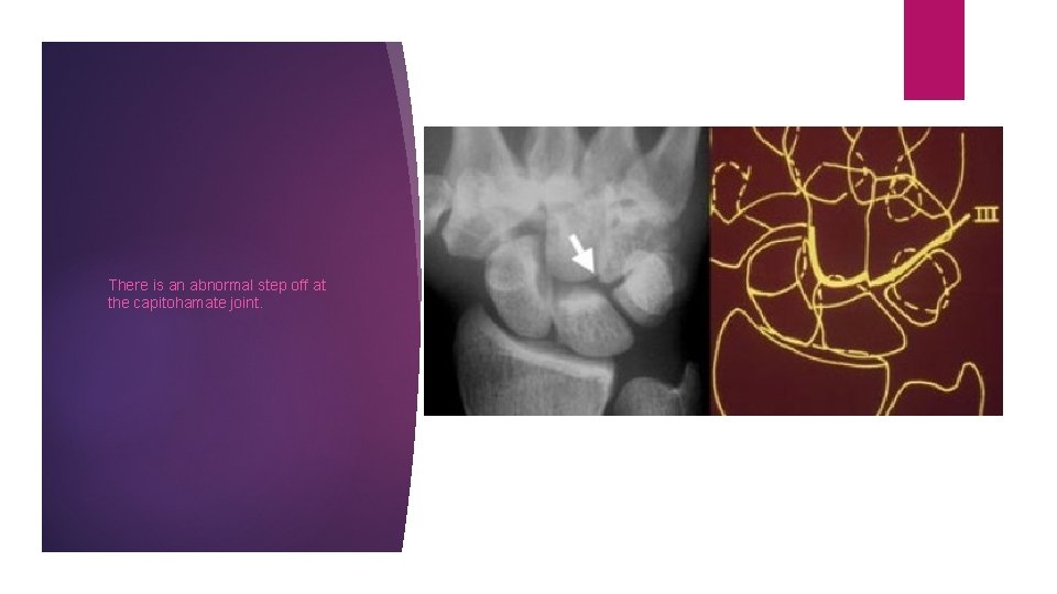 There is an abnormal step off at the capitohamate joint. 